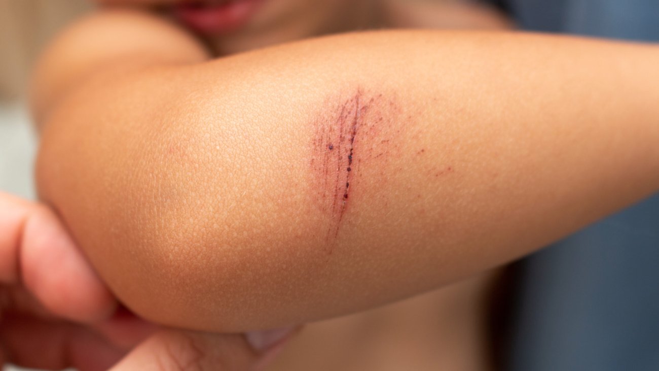 cicatrizacion-cicaderm