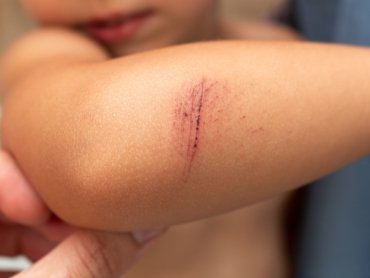 cicatrizacion-cicaderm